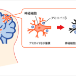 アルツハイマー病と歯周病菌