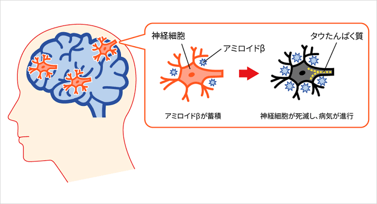 アルツハイマー病と歯周病菌