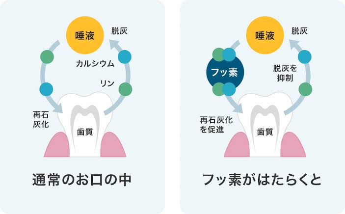 虫歯は歯ブラシが届かないところからできやすい