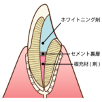 神経がない変色した歯を白くしたい！