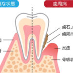 歯周病の発症って？