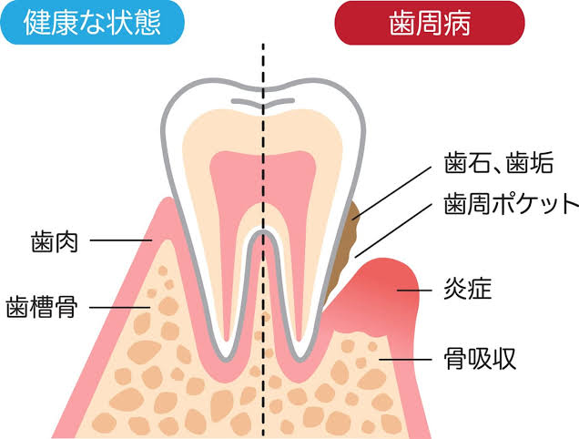 歯周病の発症って？